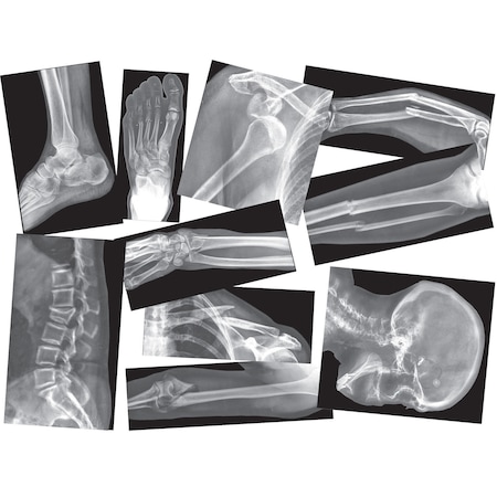 Broken Bones X-Ray Set, 15 Pieces